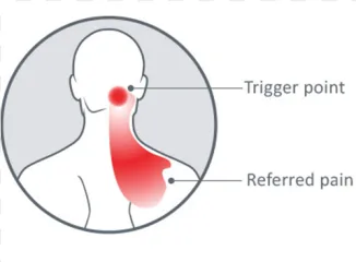 A medical diagram showing a neck trigger point and referred pain on a transparent background.